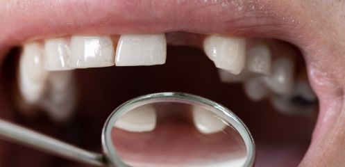 One or more missing teeth